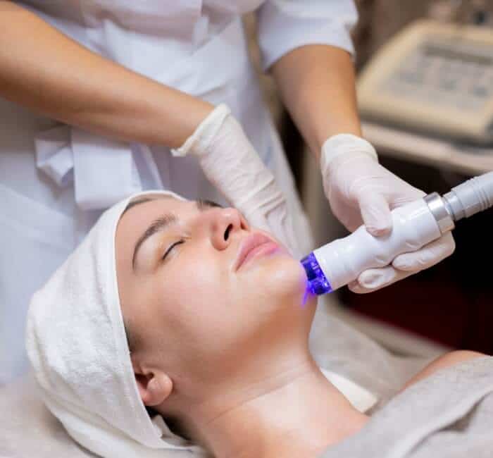 Post Acne scar treatment at Avah Clinic