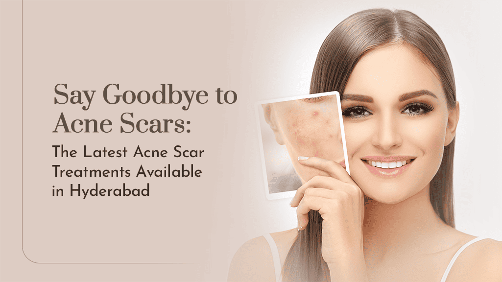 Latest Acne Scar Treatment in Hyderabad Say Goodbye to Acne