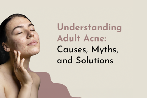 Understanding Adult Acne Treatment : Causes, Myths, and Solutions