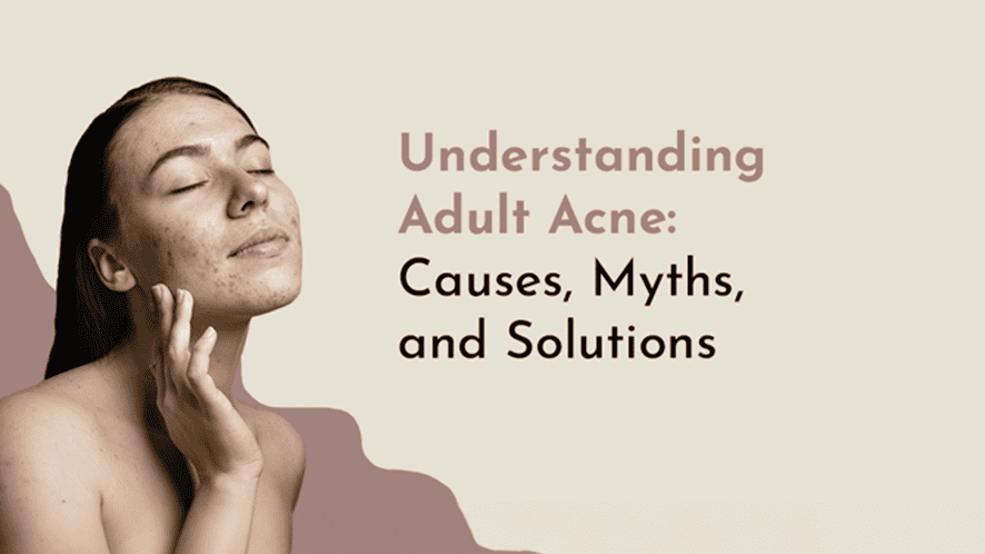 Understanding Adult Acne Treatment : Causes, Myths, and Solutions