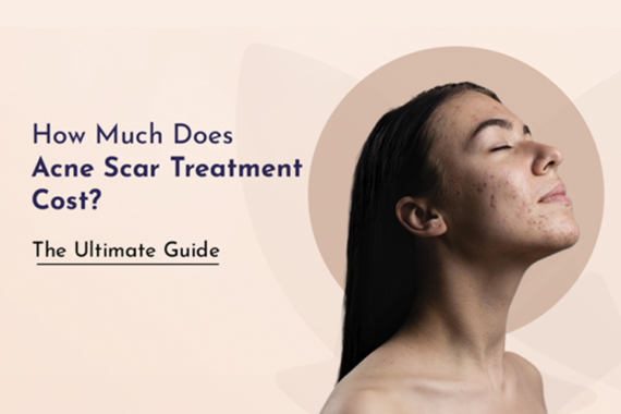 How Much Does Acne Scar Treatment Cost? The Ultimate Guide