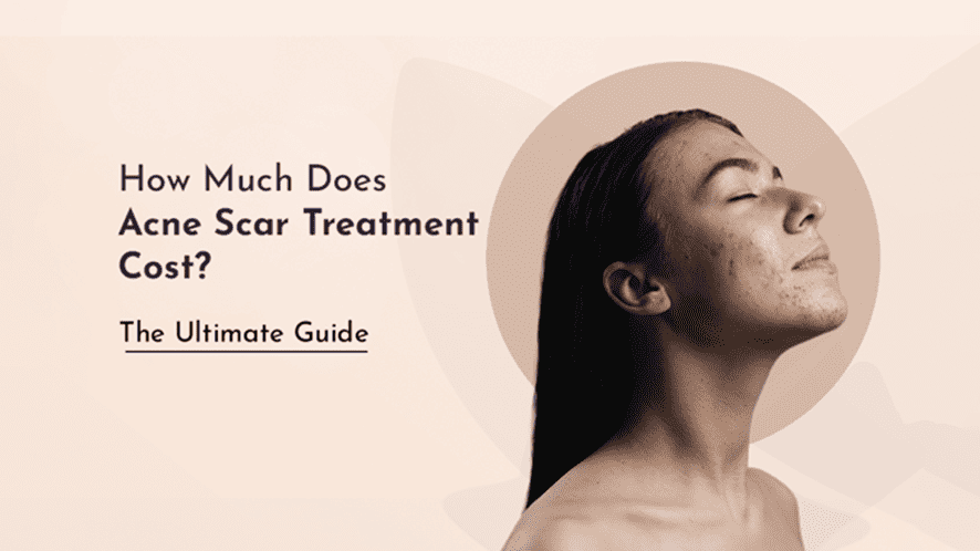 How Much Does Acne Scar Treatment Cost? The Ultimate Guide